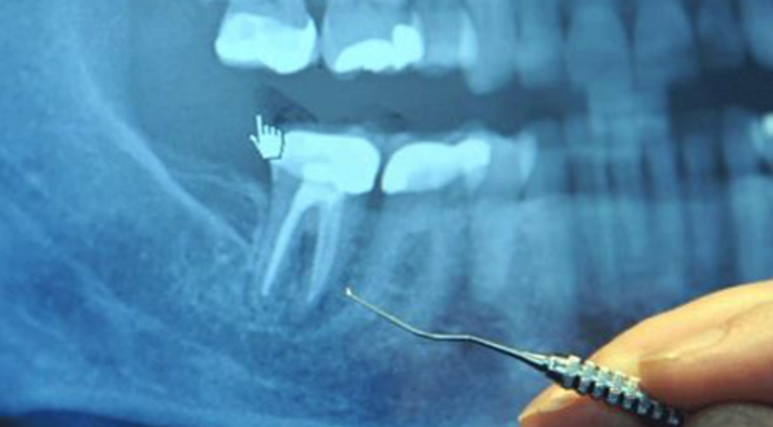 97% of Terminal Cancer Patients Previously Had This Dental Procedure
