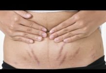 4 bio oils to aid in the fight against stretch marks