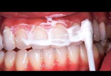 These 3 Drops Heal Cavities and Remove All Tartar From Teeth On The Same Day