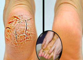 My Mother Did This When Her Heels Were Cracked. I Did Not Mention It Until I Tried It Myself