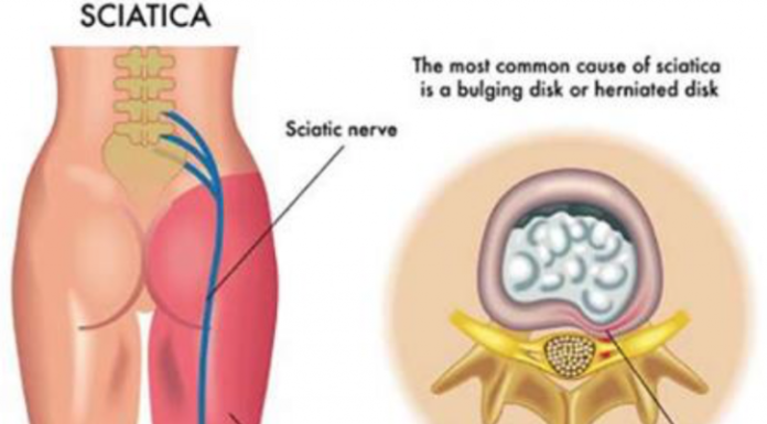 8 Natural Remedies For Sciatic Pain