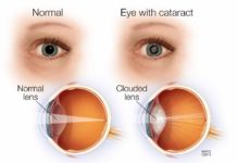 Return Your Vision And Cure Cataract Without Operation With These Remedies