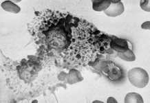 How To Starve Cancer To Death By Removing One Thing From Your Diet