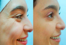 This Woman Managed To Remove Her Wrinkles In a Matter Of Hours Only With This Elixir of Youth