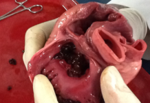 80% of Heart Attacks Could Be Avoided If Everyone Did These 5 Things