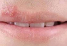 How to Get Rid Of Herpes Overnight With One Simple Trick