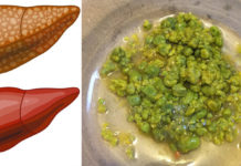 This Liver Detox Procedure Only Needs One Ingredient