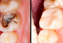 Cure Caries, Gum Disease and Whiten Teeth Using This Wonderful Remedy