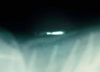 Doctor Extracts RFID Chip From Sex Trafficking Victim